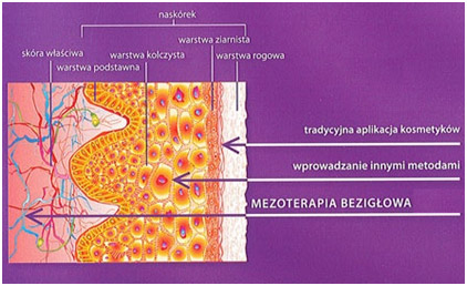 Obszar działania mezoterapii bezigłowej